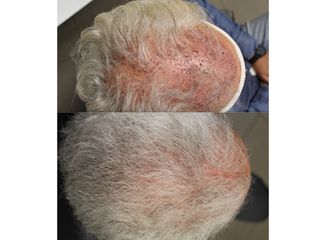 Autotrapianto capelli prima e dopo