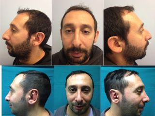Rinoplastica prima e dopo