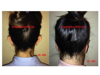 Otoplastica prima e dopo