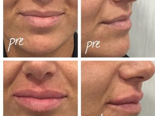 Filler labbra prima e dopo