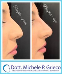 Rinofiller - Dr. Michele P. Grieco, PhD