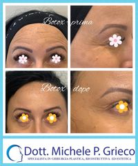 Botulino - Dr. Michele P. Grieco, PhD