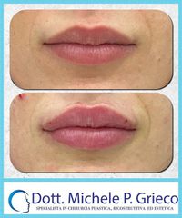Filler labbra - Dr. Michele P. Grieco, PhD