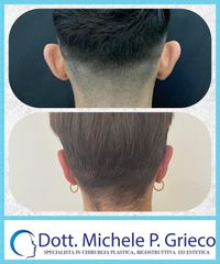 Otoplastica - Dr. Michele P. Grieco, PhD