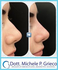 Rinofiller - Dr. Michele P. Grieco, PhD