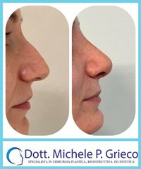 Rinofiller - Dr. Michele P. Grieco, PhD