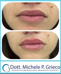 Filler labbra - Dr. Michele P. Grieco, PhD