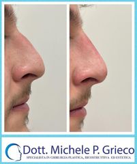 Rinofiller - Dr. Michele P. Grieco, PhD