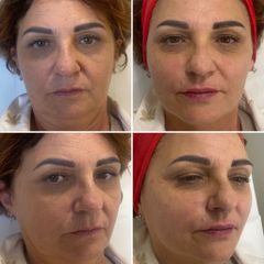 Filler - Dr Luciano Perrone