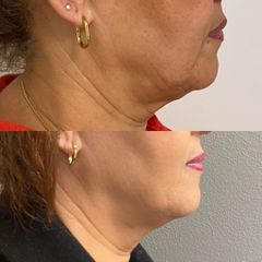 Filler - Dr Luciano Perrone