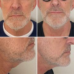 Filler - Dr Luciano Perrone