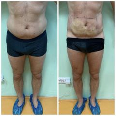 Liposuzione - Dott.ssa Francesca Mazzeo