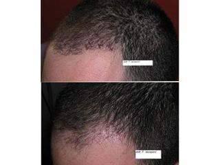 Infoltimento capelli