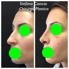 Rinoplastica - Dr. Roberto Loche