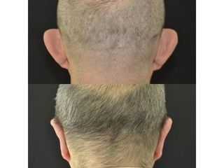 Trapianto capelli -  Dott. Emilio Trignano