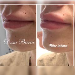 Filler labbra - Dott.ssa Ala Barac