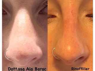 Rinofiller - Dott.ssa Ala Barac