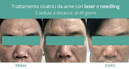 Cicatrici acne prima e dopo