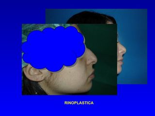 Rinoplastica prima e dopo