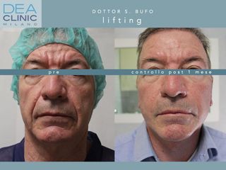 Lifting viso - Dott. Savino Bufo