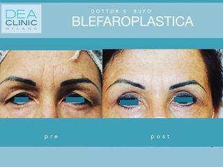 Blefaroplastica - Dott. Savino Bufo