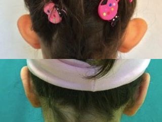 Otoplastica prima e dopo