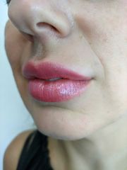 Filler labbra - Dott. David Gabriel Corona