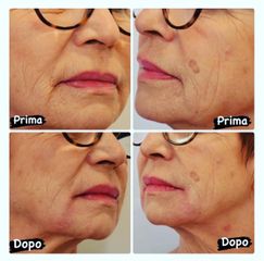 Filler rughe labio-mentoniere - Dottoressa Serafina Ghianda