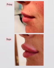 Filler labbra - Dottoressa Serafina Ghianda