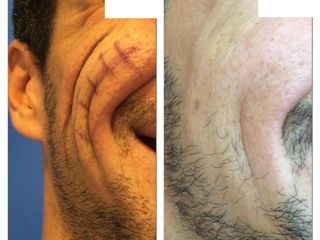 Lipofilling uomo pre e post 