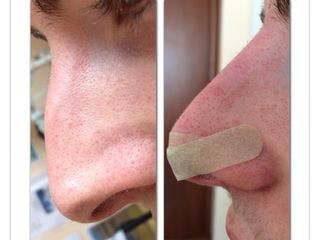 Rinofiller pre e post