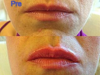 Naturale aumento labbra