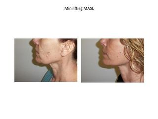mini lifting masl prima e dopo
