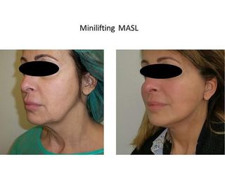 Mini lifting masl prima e dopo