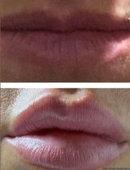 Filler labbra - Dottor Alberto Capone