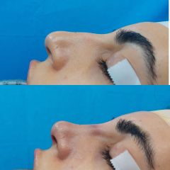 Rinoplastica - Dr. Agatino Galletta