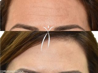 Tossina botulinica prima e dopo