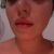 Bichectomia post 9 mesi.