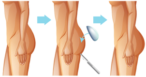gluteoplastica