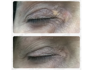 Xantelasma trucco