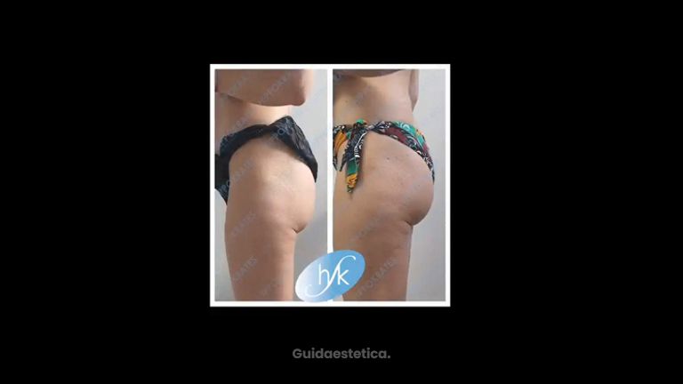 Criolipolisi - Hippokrates Centro Medico Estetico